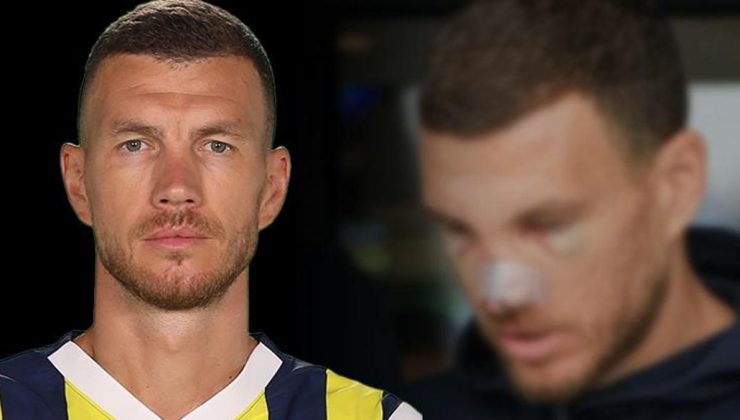 Edin Dzeko'nun görüntüsü ortaya çıktı! Burnu kırılmıştı, işte son durumu